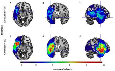 Working Memory in Aphasia: The Role of Temporal Information Processing